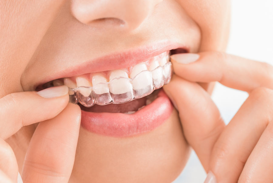 It’s Never Too Late to Straighten Your Teeth